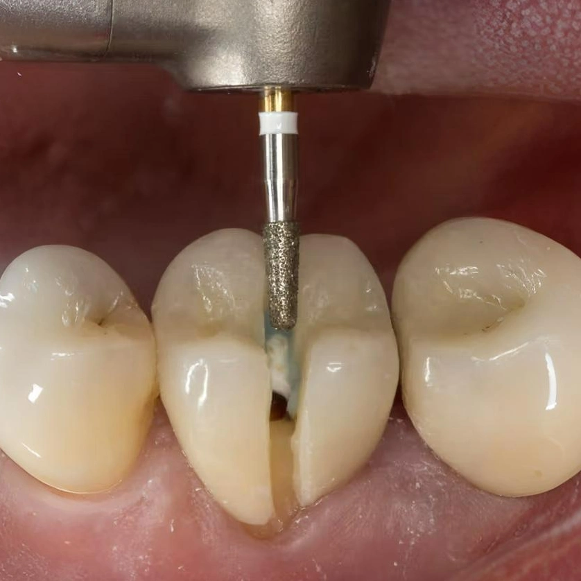 Răng sứ tháo ra không thể lắp lại khi cắt từng phần để tháo sứ